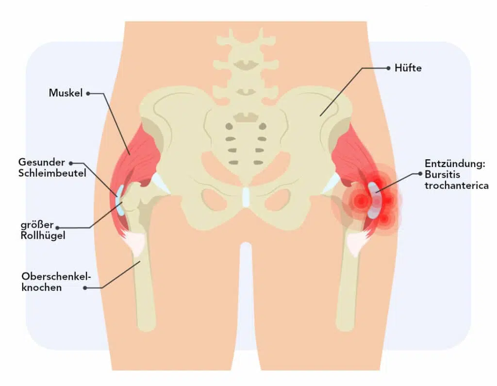 Die Grafik einer Hüfte zeigt auf der linken Seite einen gesunden Schleimbeutel und auf der rechten eine Entzündung (Bursitis trochanterica).