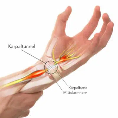 Der Unterarm und die Hand auf diesem Bild sind grafisch bearbeitet, um die anatomischen Hintergründe eines Karpaltunnelsyndroms darzustellen. Der Karpaltunnel ist eingekreist. Hier sieht man den Mittelarmnerv, der unter dem Karpalband verläuft.