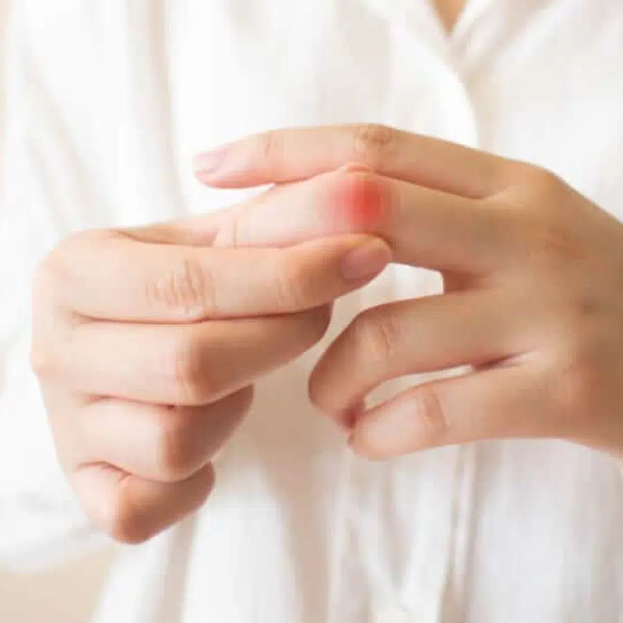 Die rechte Hand einer Frau umfasst an ihrer linken Hand den Zeigefinger. Ein Fingergelenk am Zeigefinger ist rot gefärbt, um auf eine Entzündung hinzudeuten.
