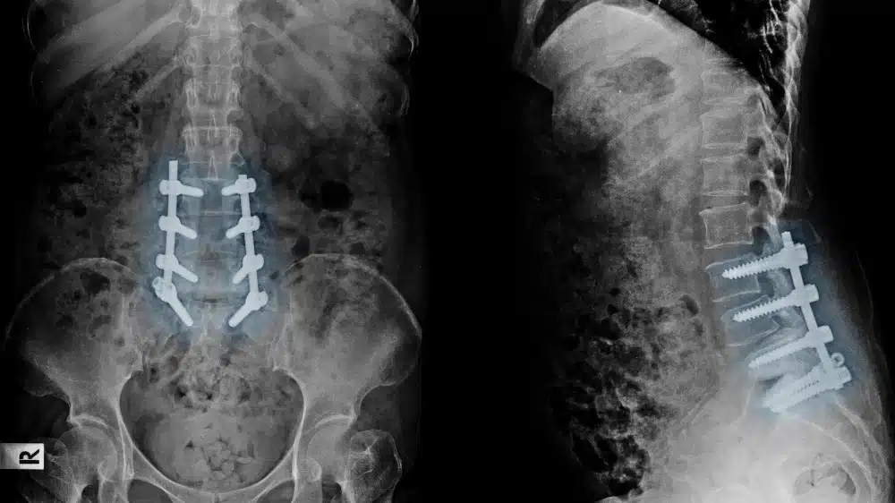 Röntgenbild von Rumpf frontal und von der Seite mit Schrauben in einzelnen Wirbeln