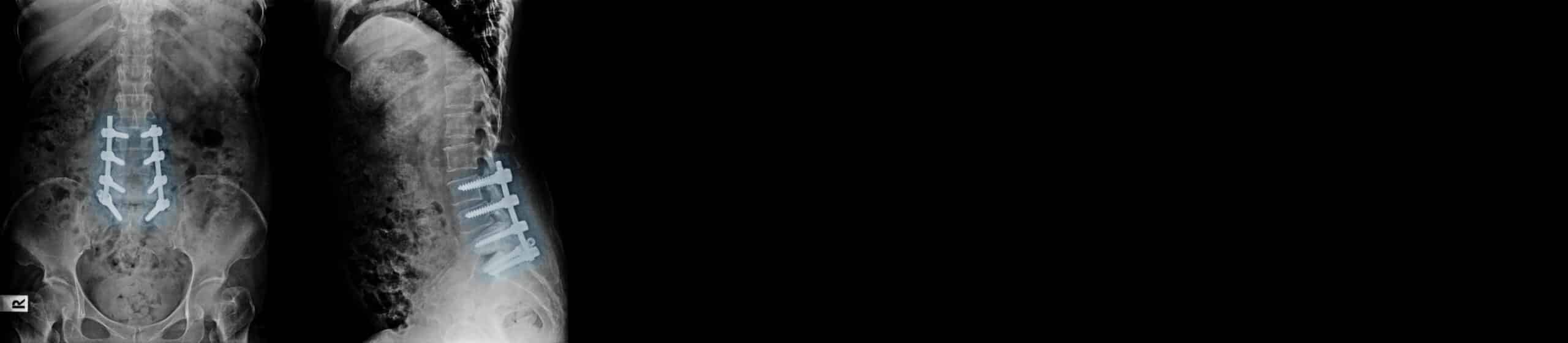 Röntgenbild von Rumpf frontal und von der Seite mit Schrauben in einzelnen Wirbeln