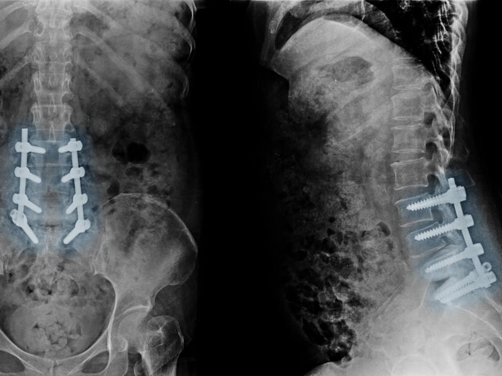 Röntgenbild von Rumpf frontal und von der Seite mit Schrauben in einzelnen Wirbeln