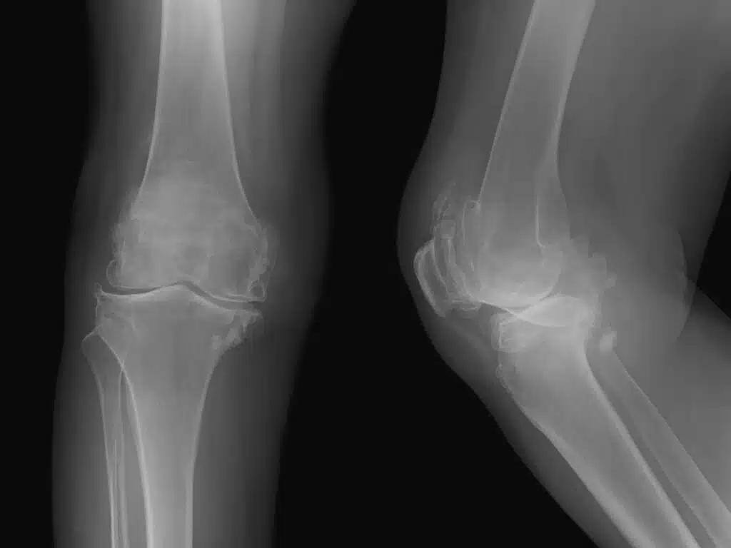Röntgenbild von Kniegelenk mit Arthrose von vorne und von der Seite