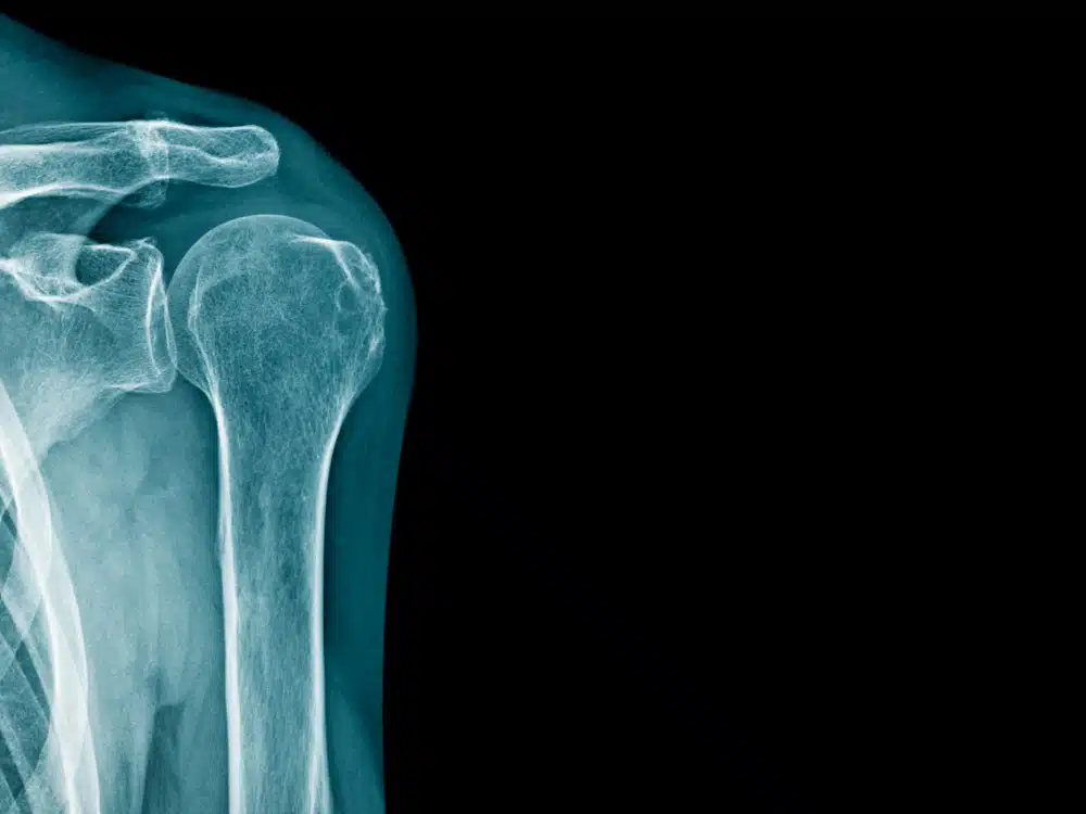 Röntgenbild Schulter