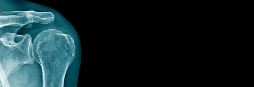 Röntgenbild Schulter