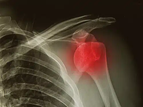 Symbolbild entzündetes Schultergelenk