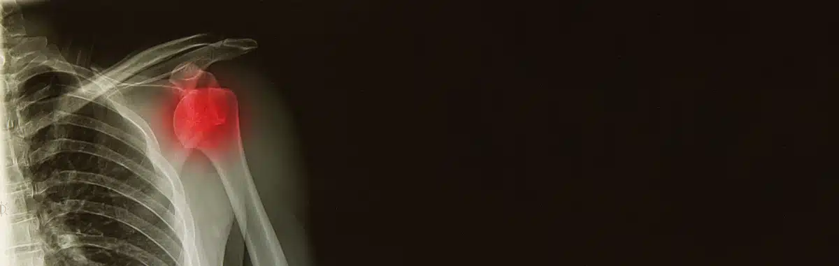 Symbolbild entzündetes Schultergelenk