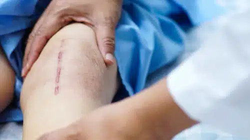 Bein mit langer Operationsnarbe am Knie, Hände von Arzt oder Therapeut betasten Bein