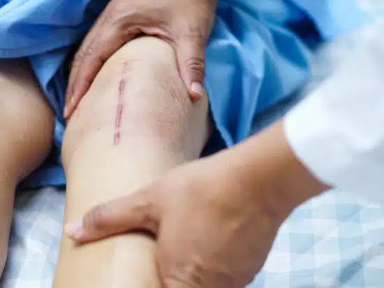 Bein mit langer Operationsnarbe am Knie, Hände von Arzt oder Therapeut betasten Bein