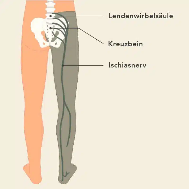 Grafik zu Anatomie und Verlauf des Nervus ischiadicus. Der Ischiasnerv entspringt den untersten Wirbeln, verläuft durch das Becken und die Rückseite der Oberschenkel hinunter bis in den Fuß.