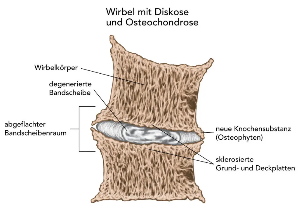 Grafische Darstellung zweier Wirbel, die von Osteochondrose und Diskose betroffen sind. Die Wirbelflächen sind sklerosiert und bilden Knochenwucherungen.