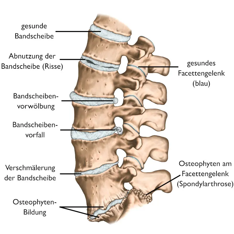 Grafische Darstellung eines Wirbelsäulenabschnittes mit sieben Wirbeln und dazwischenliegenden Bandscheiben. Die Bandscheiben weisen verschiedene Veränderungen wie Abnutzung, Vorwölbung, Vorfall und Verschmälerung auf. An zwei Wirbeln haben sich Osteophyten gebildet. Außerdem ist ein gesundes und ein an Arthrose erkranktes Facettengelenk gekennzeichnet.