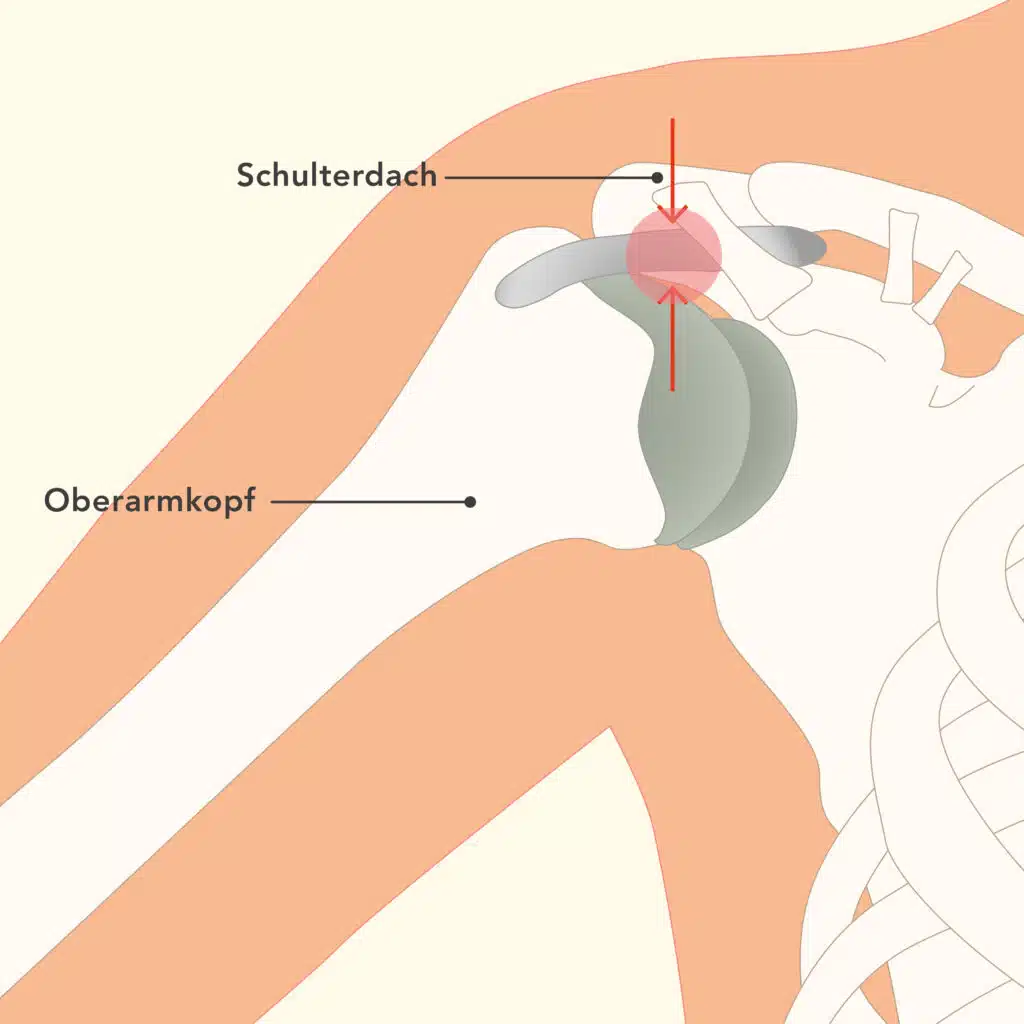 Anatomische Grafik, die die Schulter mit einem Impingement-Syndrom zeigt. Das Gewebe zwischen Schulterdach und Oberarmkopf ist rötlich eingefärbt.