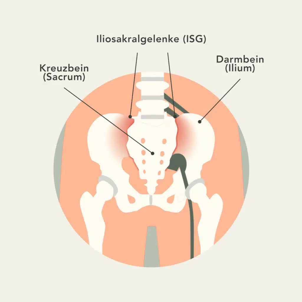 Anatomische Grafik eines ISG mit Darmbein und Kreuzbein.