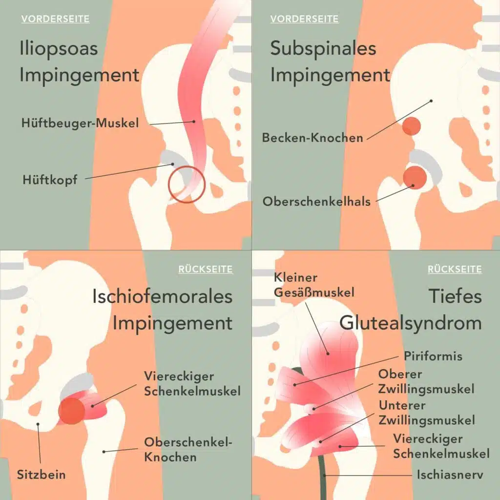 Im Bild sind vier separate Grafiken der Hüfte zu sehen. Oben sieht man auf der Vorderseite der Hüfte die Anatomie bei einem Iliopsoas Impingement (links) und das subspinale Impingement (rechts ). Unten ist die Rückseite der Hüfte dargestellt. Man sieht die Anatomie bei einem Ischiofemoralen Impingement (links) und einem tiefen Glutealsyndrom (rechts).