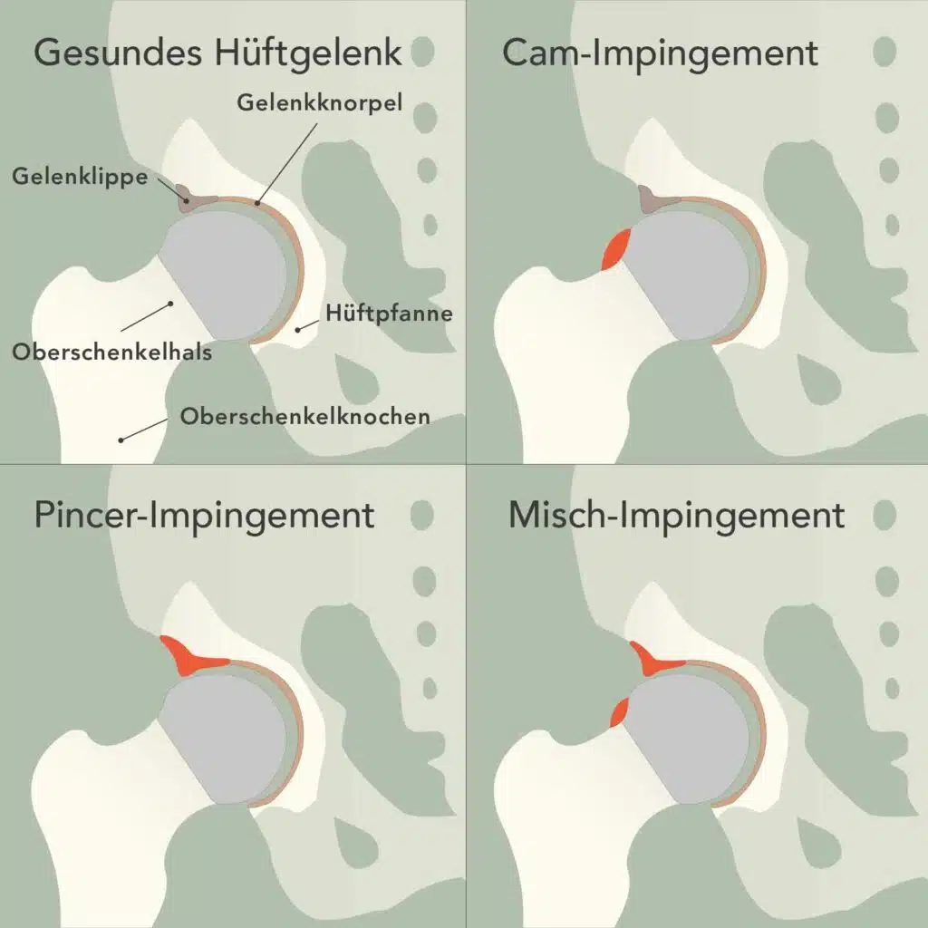 Im Bild sind vier separate Grafiken zu sehen. Oben links ist das gesunde Hüftgelenk mit Beschriftung von Oberschenkelhals, Hüftpfanne und Gelenklippe. Daneben sieht man oben rechts anatomische Veränderungen eines Cam-Impingements in der Hüfte. Unten links die Veränderungen bei einem Pincer-Impingement und unten rechts eine kombinierte Form beim Misch-Impingement.