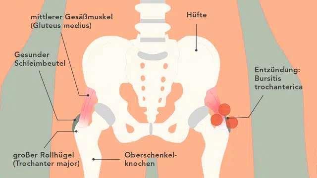Anatomische Grafik mit der Hüfte, dem mittleren Gesäßmuskel, einer Schleimbeutelentzündung, dem Oberschenkelknochen und dem großen Rollhügel.