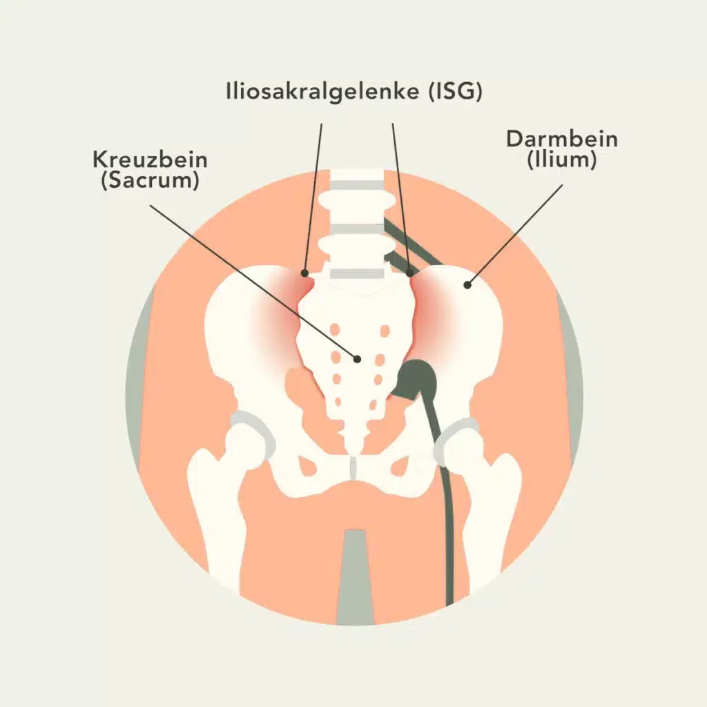 Anatomische Grafik eines ISG mit Darmbein und Kreuzbein.