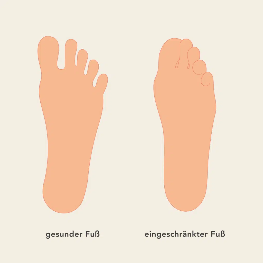 Die Grafik zeigt links einen gesunden Fuß, bei dem die Zehen breit und eher gespreizt sind. Rechts ist ein eingeschränkter Fuß zu sehen, bei dem die Zehen eng aneinander liegen und sich überlappen.