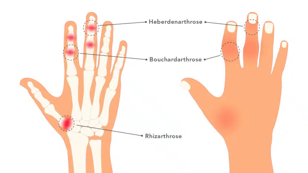 Auf der Grafik sind die Fingerarhtrose-arten Heberdenarthrose, Bouchardarthrose und Rhizarthrose an den jeweiligen Gelenken der Hand eingezeichnet.