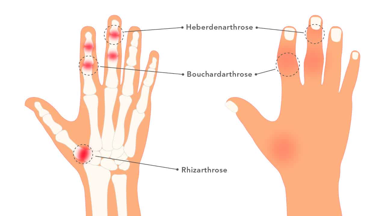 Arthrose Finger Rheuma Finger Anfangsstadium fity.club