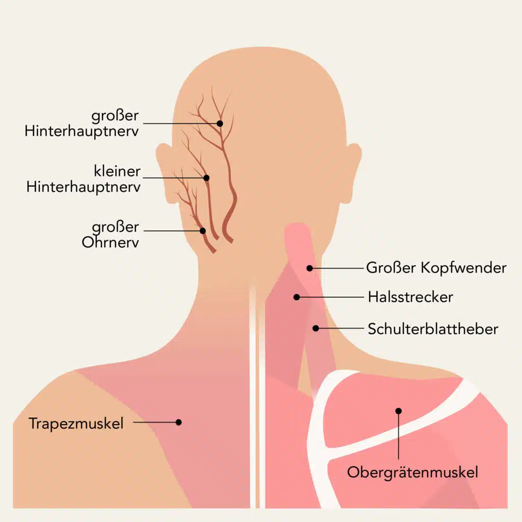 Nackenschmerzen können auf zahlreiche Nerven wirken und so auch Kopfschmerzen bedingen.