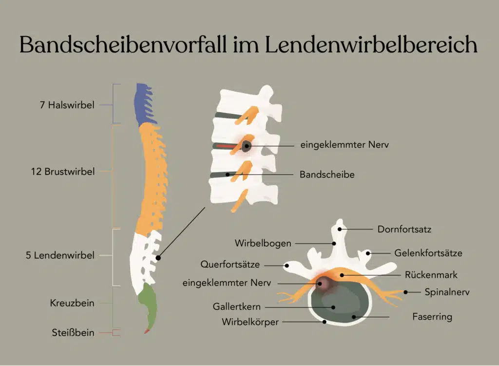 Ein Bandscheibenvorfall entsteht meist im Lendenwirbelbereich, da dieser Bereich oftmals großen Spannungen ausgesetzt ist.