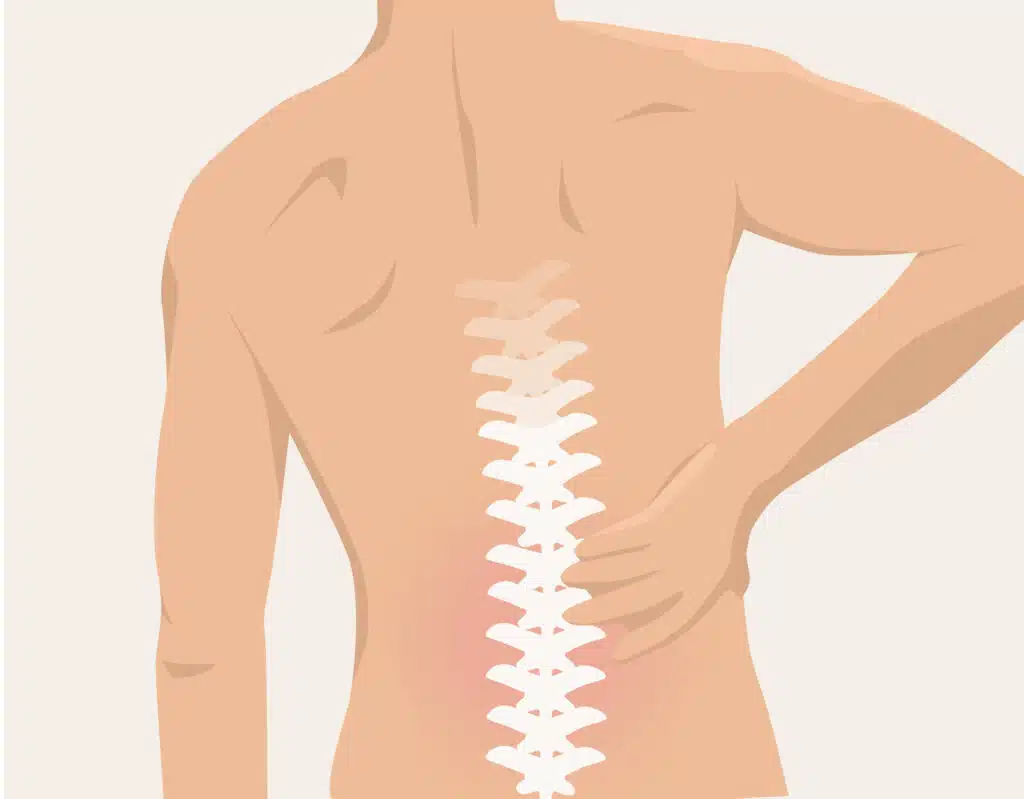 Ein häufiger Grund für Ischiasschmerzen sind muskuläre Verspannungen.