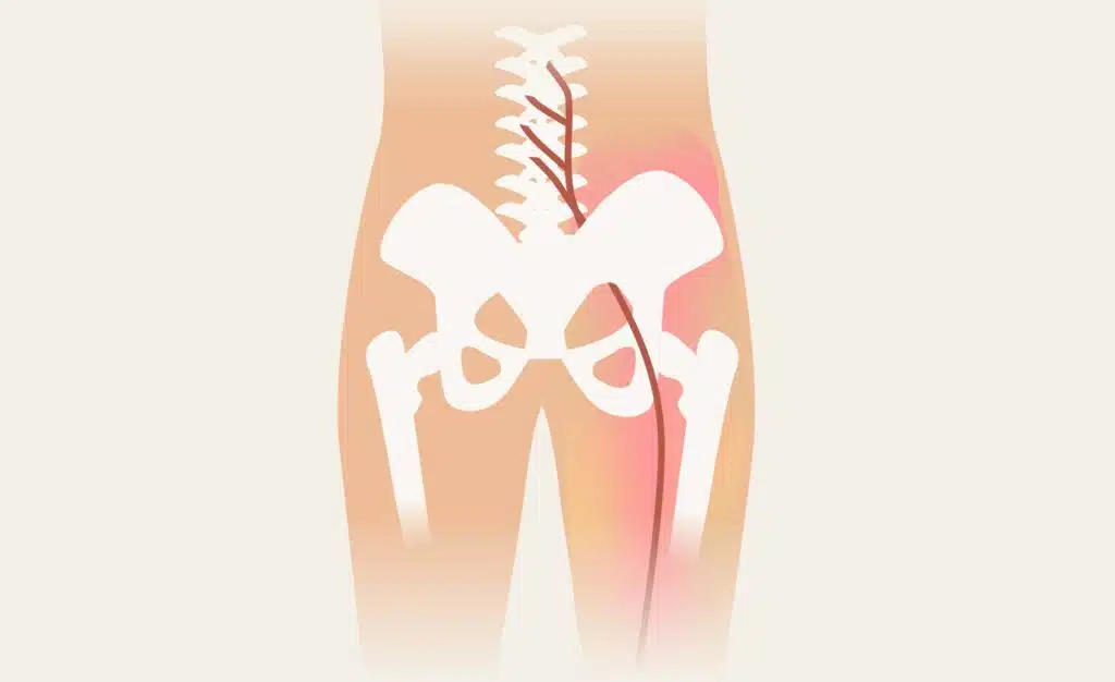 Ischias-Schmerzen können vom unteren Rücken bis hinunter in den Fuß spürbar sein.