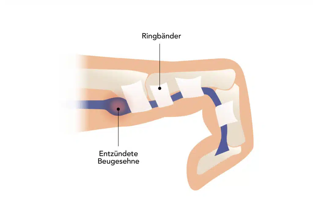Beim Schnappfinger kann der Patient den Finger nicht mehr schmerzfrei strecken.
