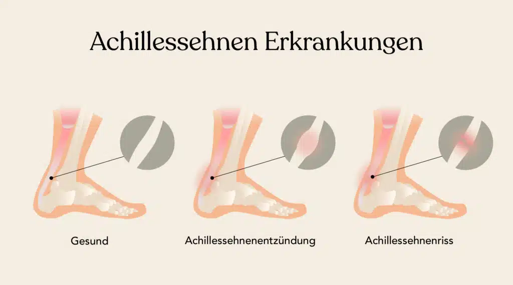 Bei Achillessehnenschmerzen kann eine einfache Entzündung oder sogar ein Riss in dem Bereich dahinterstecken.