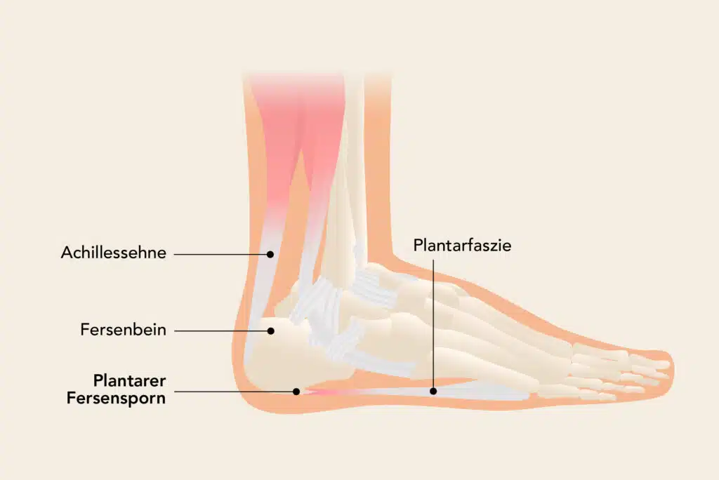 Plantarer Fersensporn