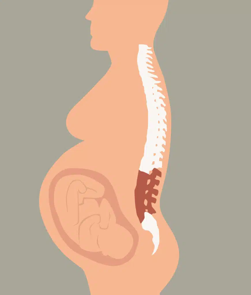 Schwangerschaft Bandscheibenvorfall Ansicht der Wirbelsäule und Bandscheiben