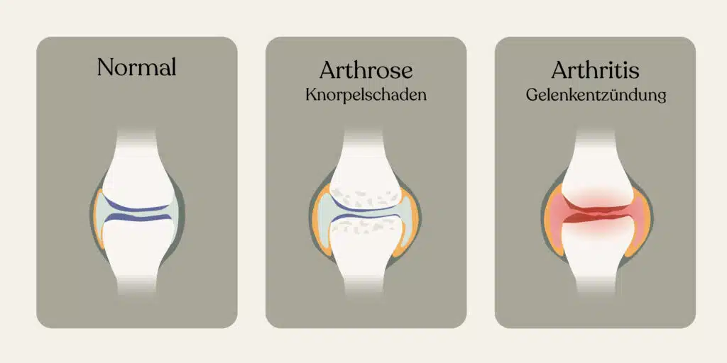 Arthrose Arthritis Unterschied