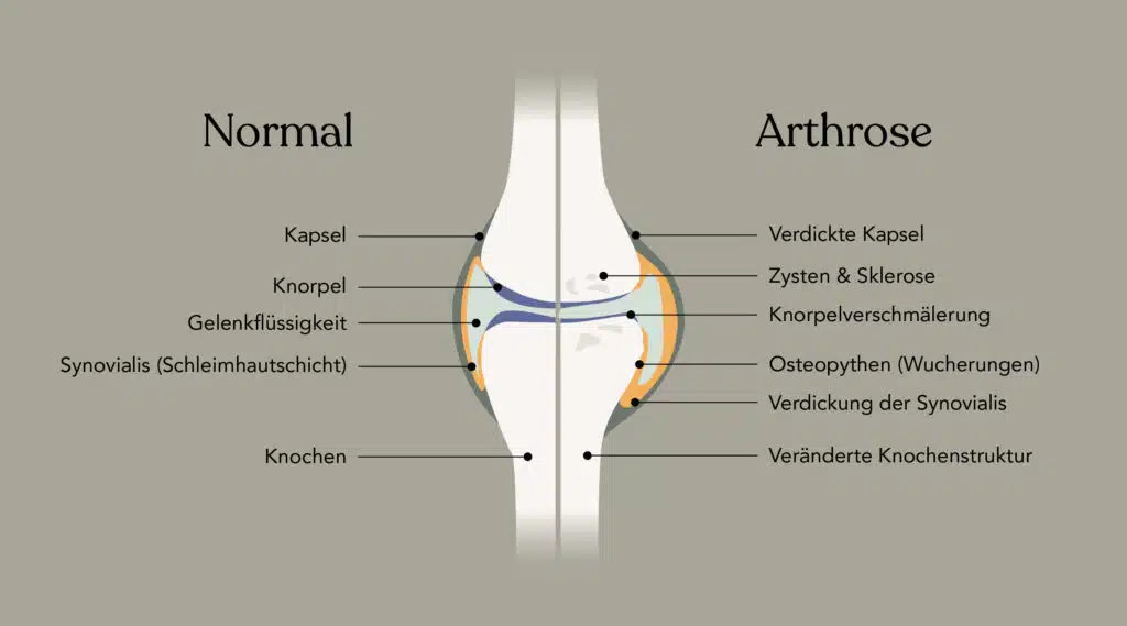 Was ist Arthrose: Darstellung eines Gelenkes mit Arthrose