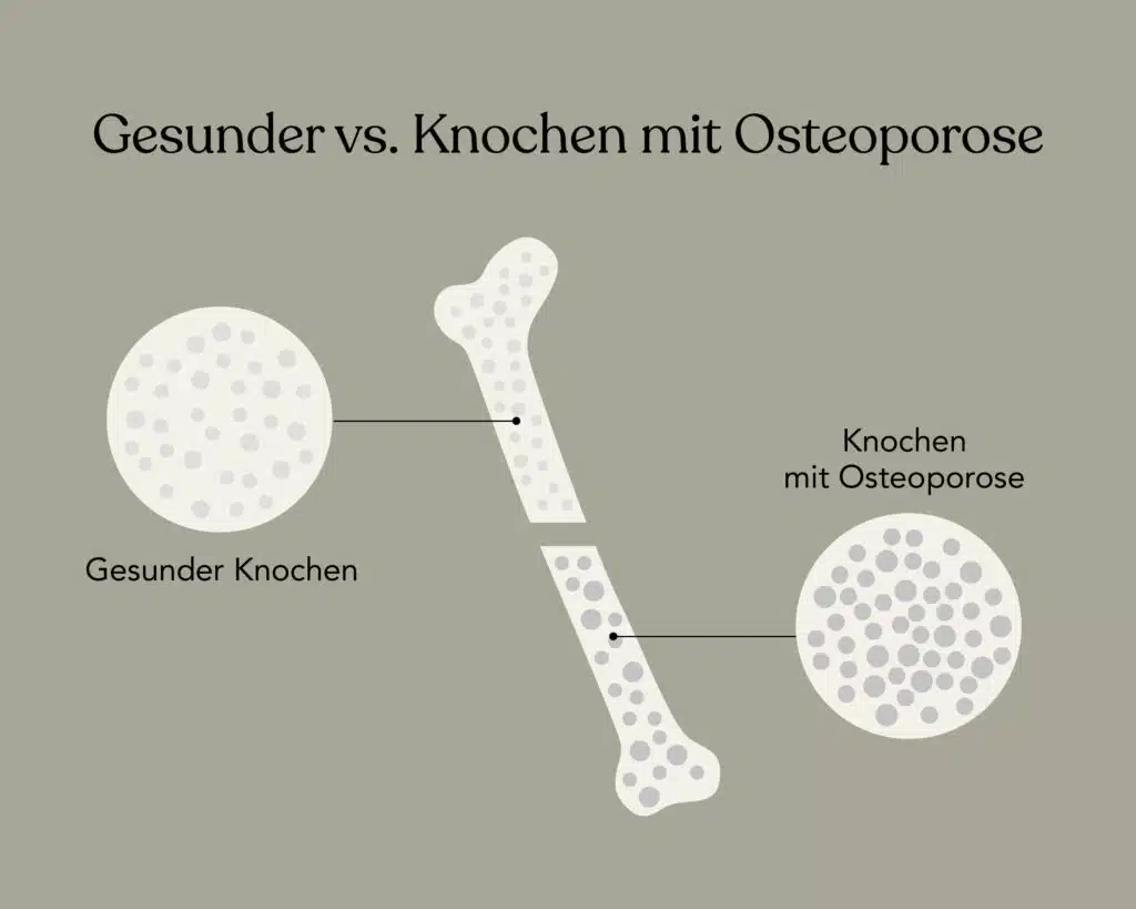 Was ist Osteoporose: Unterschied gesunder Knochen vs. Knochen mit Osteoporose
