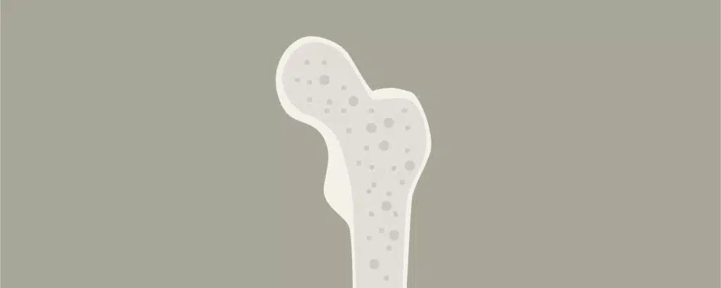 Osteoporose verstehen