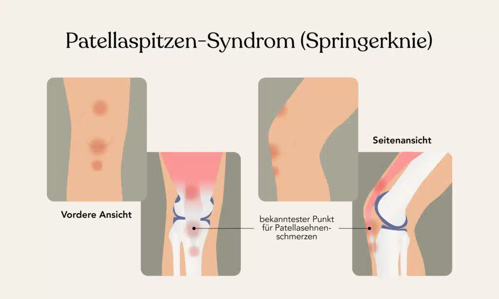 Frontale und seitliche Ansicht eines Kniegelenks: Bei der Patellasehnenreizung könnten Probleme mit der Kraftübertragung auftreten und die Schmerzen bis in den Unterschenkel ausstrahlen.