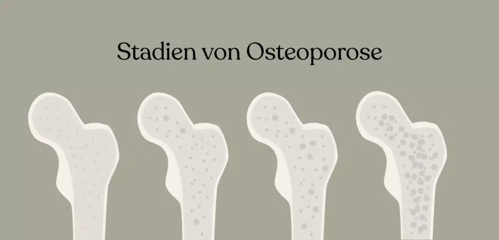 Osteoporose-Stadien