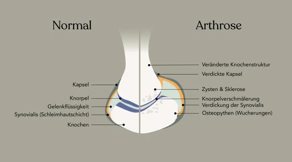 Vergleichende Darstellung eines normalen Gelenks (links) und eines arthrotischen Gelenks (rechts) im Querschnitt. Durch die typischen Veränderungen bei Arthrose wie Knorpelabbau und Knochenwucherungen können Patienten darunter leiden, dass die Gelenkflächen aufeinander reiben.