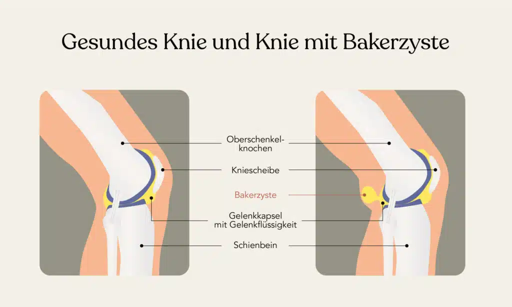 Wie Lange Dauert Es Bis Sich Eine Bakerzyste Zurückbildet www.liebscher-bracht.com