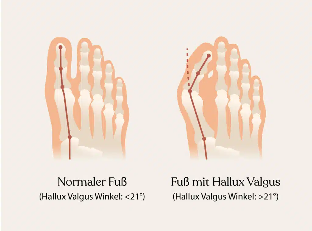 Links siehst du, einen normalen Fuß, mit einem Winkel von unter 21 ° – beim Hallux Valgus kann der Winkel deines großen Zehs größer als 21 ° sein und über die anderen Zehen hinausragen.