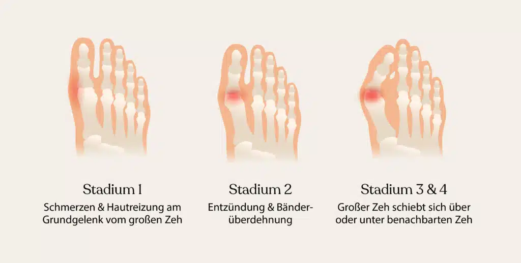 Im Stadium 1 können Hautreizungen und Schmerzen am Grundgelenk entstehen. Im Stadium 2 könntest du entzündete oder überdehnte Bänder bemerken. Im Stadium 3 und 4 könnte sich dein Großzehengrundgelenk so weit verschieben, dass der Zeh über die benachbarten Zehen hinausragt.