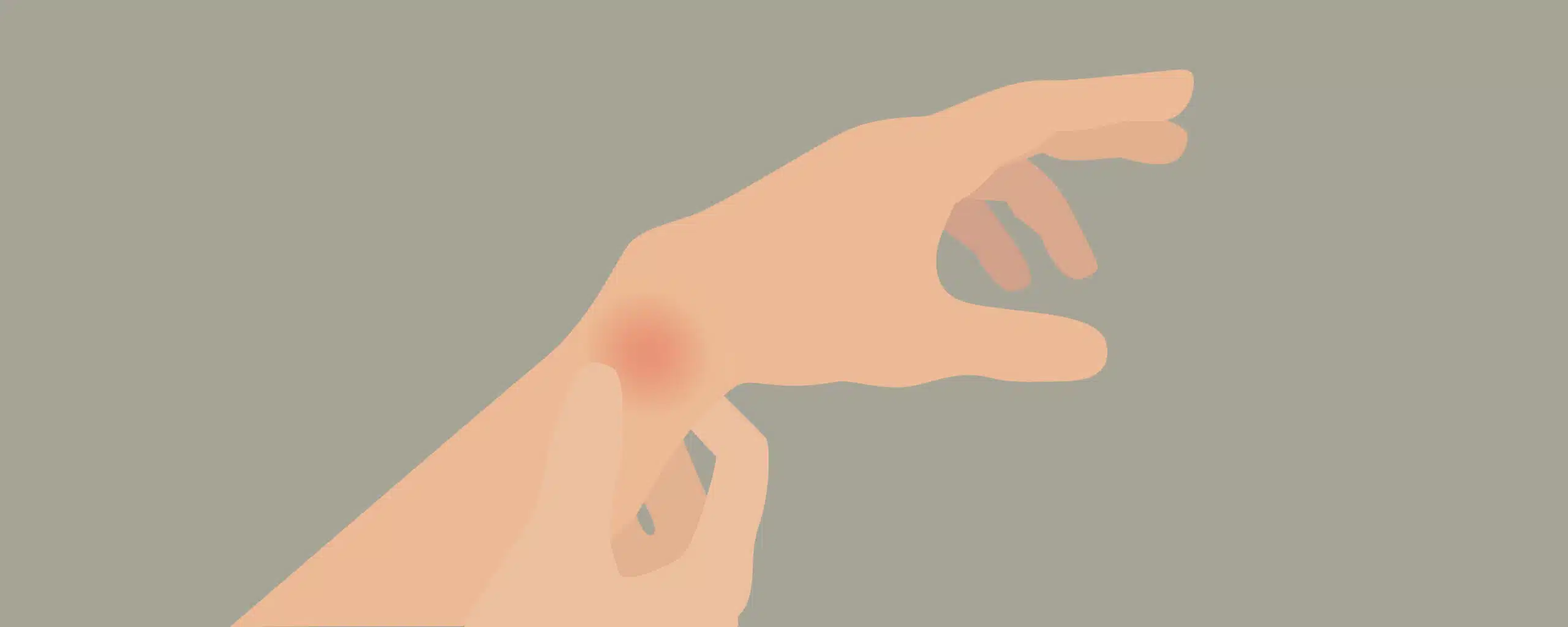 Eine Person mit Karpaltunnelsyndrom hält sich die schmerzende Hand.