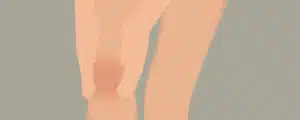 Meniskus-Schmerzen können eine häufige Ursache für Schmerzen am Knie sein.