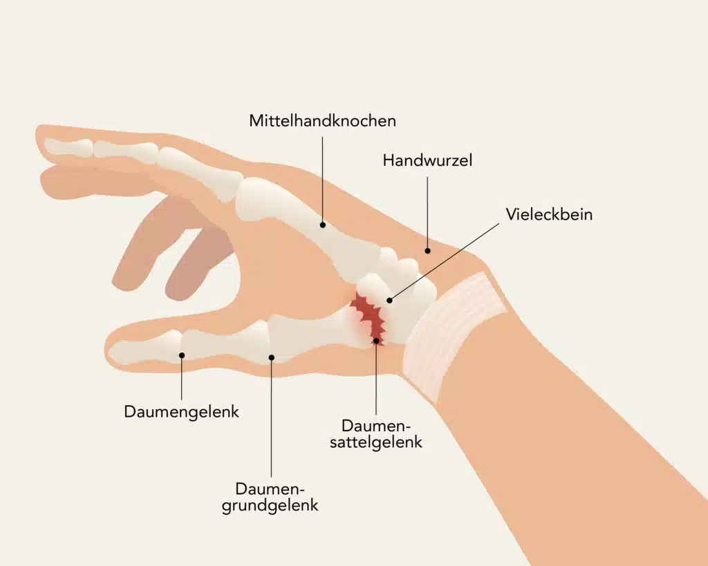 Eine Person mit Arthrose am Daumensattelgelenk, auch Carpometacarpalgelenk genannt.