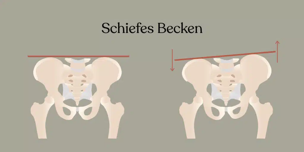Ein Beckenschiefstand kann ebenfalls Becken-Schmerzen verursachen