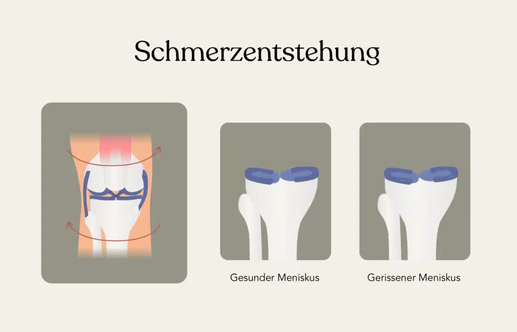Schmerzentstehung bei Meniskus-Schmerzen