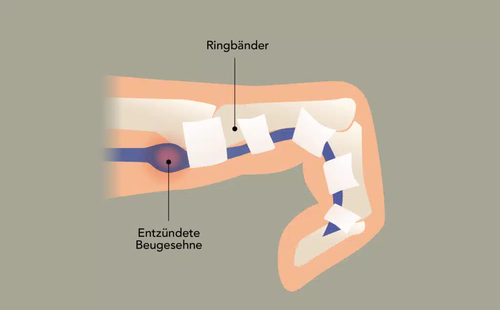 Verdickte Sehnen bilden Knötchen und passen nicht mehr durch das Ringband.