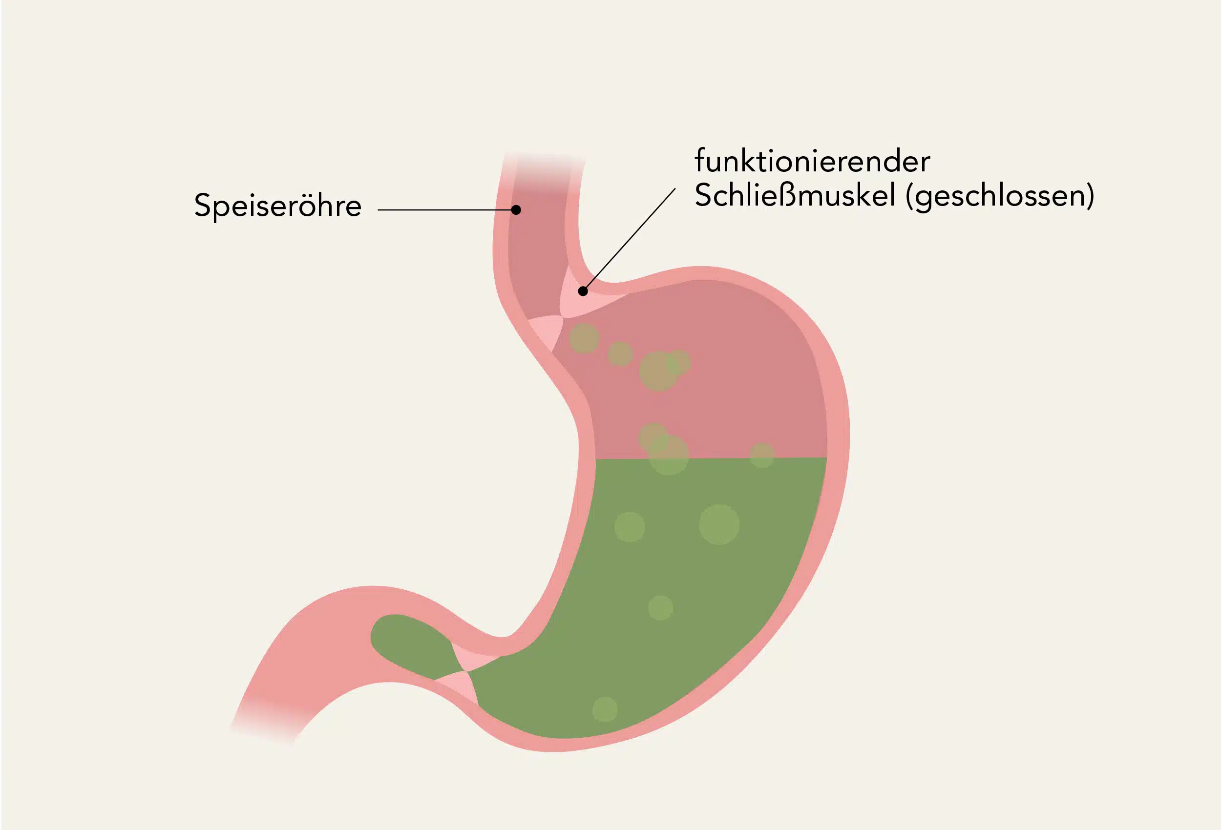 Beim gesunden Magen sollte der Schließmuskel dafür sorgen, dass der Magensaft nicht aufsteigen kann.